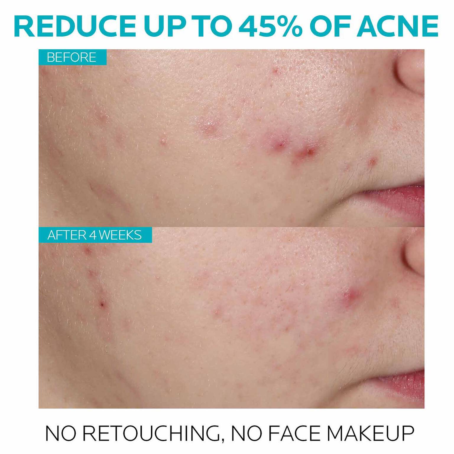 effaclar-salicylic-acid-acne-treatment-serum-v0 7_EffaclarSerum_After-45-days.jpg