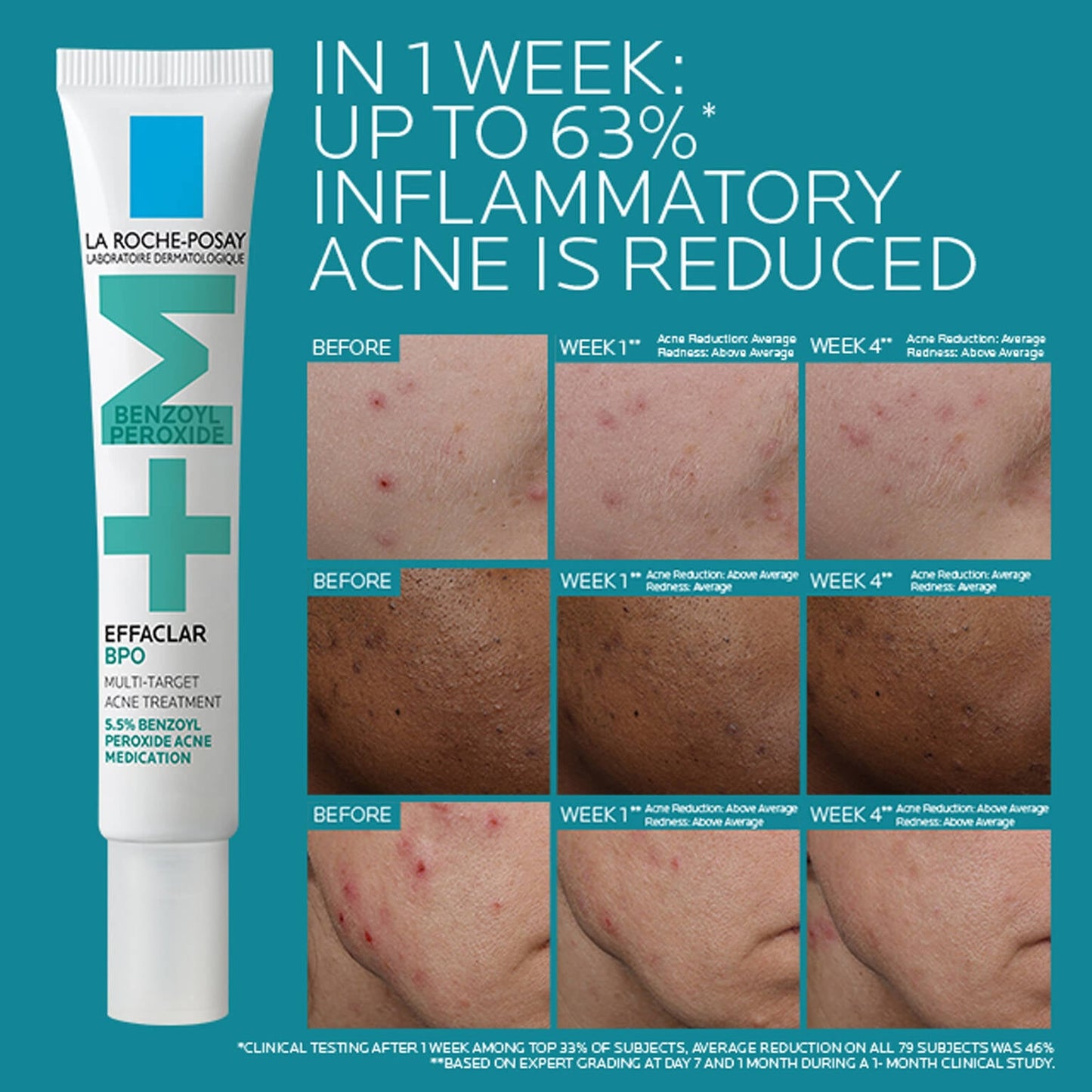 effaclar-bpo-multi-target-acne-treatment-with-5-5-benzoyl-peroxide-c3 EffaclarBPO-ClinicalBA-ATF-1500x1500-2.jpg